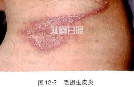 隐翅虫咬人后图片隐翅虫叮咬后皮肤炎