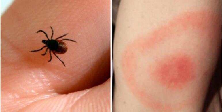 蜱虫咬人的伤口图片蜱虫咬人后有什么症状